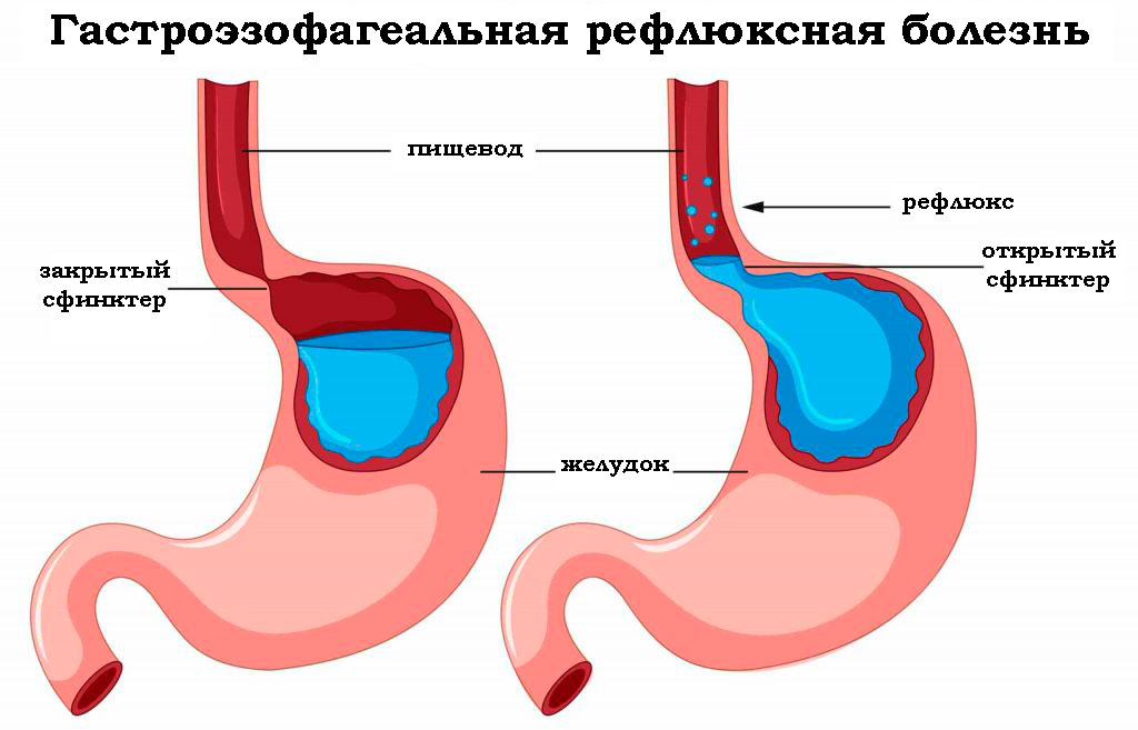 лечение ГЭРБ